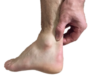 Podiatrists at Northern Foot Clinic frequently treat people with Achilles tendon pain