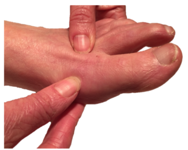 Podiatrists at Northern Foot Clinic frequently treat people with bunions / big toe joint pain