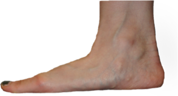 Flat feet are frequently managed by podiatrists at Northern Foot Clinic